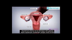 ЭНДОМЕТРИОЗ НИМА?