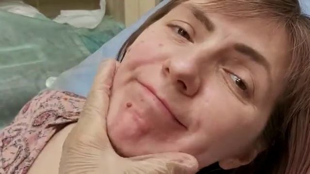 Филлер, заполнение носогубной складки.