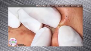 ВЫДАВЛИВАНИЕ ЧЕРНЫХ ТОЧЕК И УГРЕЙ НА ЛИЦЕ. ЧИСТКА ПУТЕМ ВЫДАВЛИВАНИЯ!!!