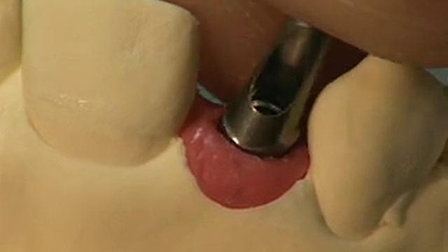 Изготовление 2-х одиночных коронок на имплантах.