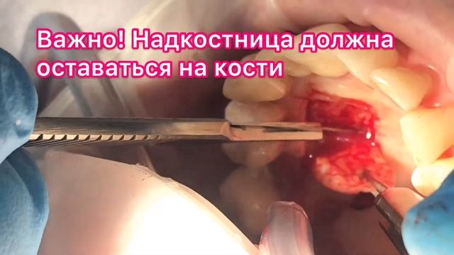 Пересадка свободного десневого трансплантанта с неба. Пересадка  десны при имплантации.