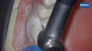 ПРЕПАРИРОВАНИЕ ПОД ПОЛНУЮ КОРОНКУ(подробная инструкция)