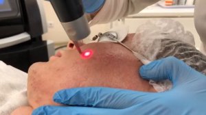 Лечение рубцов постакне на пикосекундном лазере PicoSure