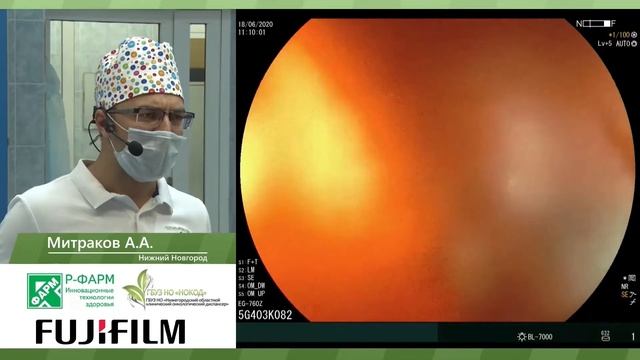 Диагностика и удаление опухоли методом подслизистой диссекции. А. А. Митраков смотреть онлайн