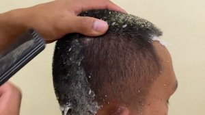 DRY SCALP !! Big Flakes Dandruff Scratching Satisfying Video #758