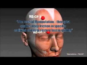 Fascial Manipulation® по Луиджи Стекко, что это? (англ).