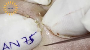 Perfect Extraction of Blackheads on the Lips