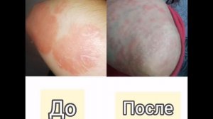 Псориаз - приговор? Или есть решение?