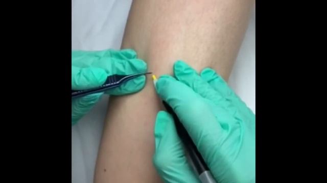 Электроэпиляция ног спб. Центр Элеганте смотреть онлайн