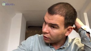 Пересадка волос в Турции. Отчет 6 месяцев после пересадки волос. Minoxidil4you пересадка волос