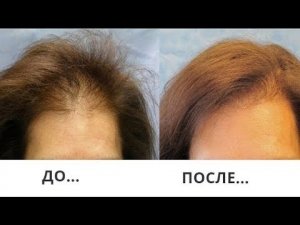 Просто Быстро Дёшево! Сильная маска от Выпадения волос! Гипотириоз!  
Маска от выпадения волос!
