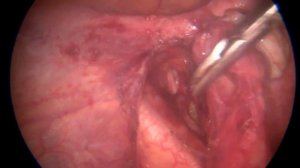 Клиппирование маточных артерий с озвучкой