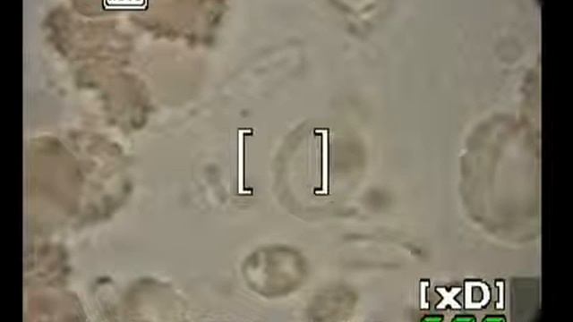 23 Кровь при диабете смотреть онлайн