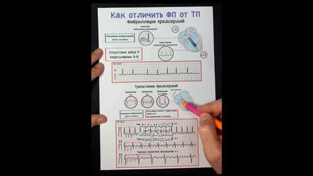 Как отличить фибрилляция предсердий от трепетания