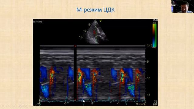 Эхокардиографическая оценка внутрисердечной гемодинамики смотреть онлайн