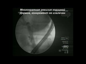 ЭПСТ. Литоэкстракция корзиной и баллоном