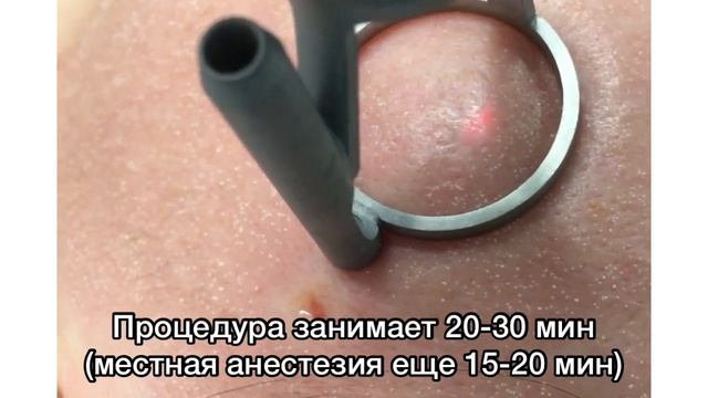 Лазерная шлифовка кожи лица смотреть онлайн