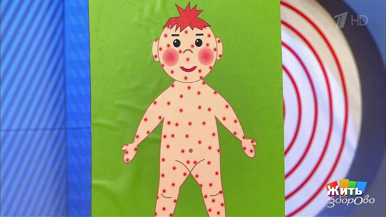 Летние болезни у детей. Жить здорово! Фрагмент выпуска от 01.08.2017