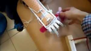 Установка протеза кисти