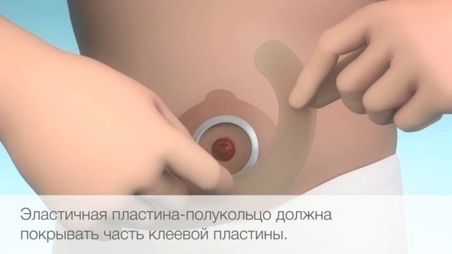 Эластичная пластина полукольцо Brava (Coloplast) - фиксация пластин калоприемников и уроприемников.