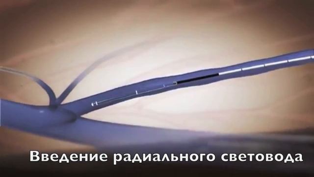 Лазерное лечение варикоза (ЭВЛК) с использованием радиальных световодов