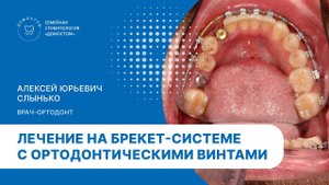 Лечение на брекет-системе с ортодонтическими винтами