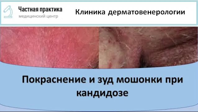 Покраснение и зуд мошонки при кандидозе