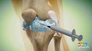 Боремся с артритом без таблеток. Жить здорово! Фрагмент выпуска от 12.10.2017