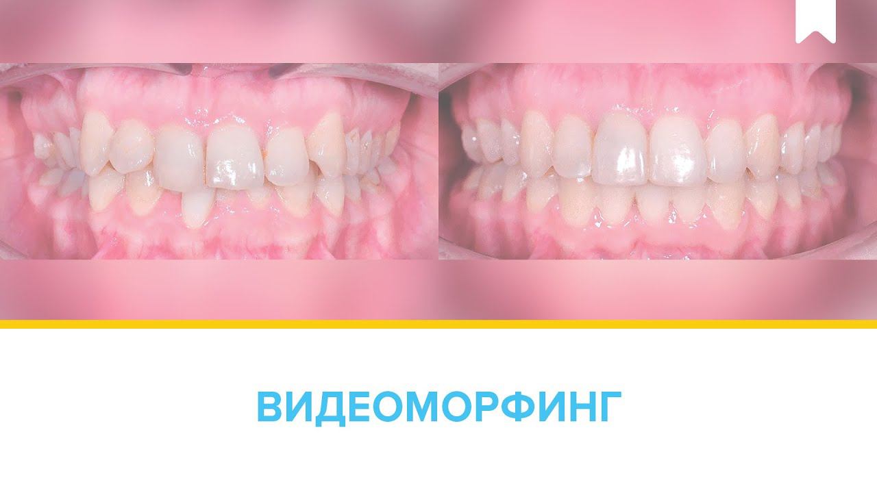 Результат нестандартного решения. Лечение скученности с удалением нижнего резца цифровыми брекетами