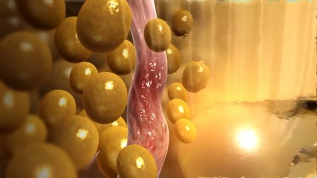 Радиочастотная липосакция смотреть онлайн