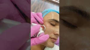 Лазерная шлифовка лица