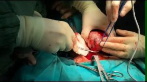 Рак щитовидной железы. Big Thyroid.