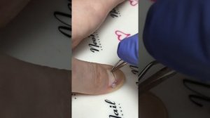 Установка корректирующей системы (титановая нить) на ноготь на руке, подолог Ольга Кострюкова