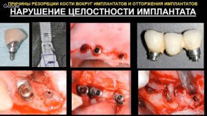 Непосредственная имплантация после удаления имплантата фрагмент вебинара