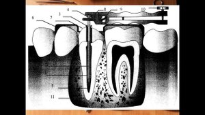 Инструменты для атравматичного удаления зуба.