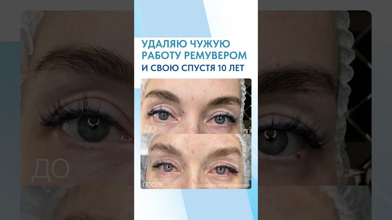 Удаление стрелок лазером | Удаление бровей ремувером