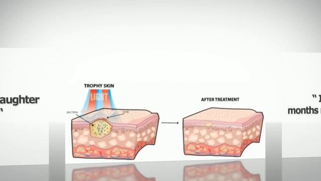 The BlueMD - Acne Blue Light Therapy Treatment At Home смотреть онлайн