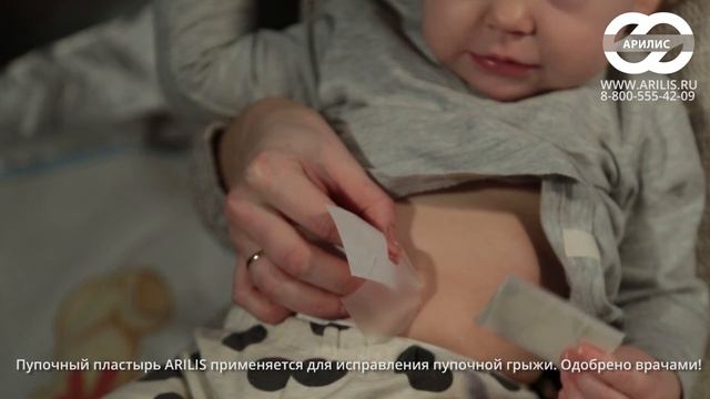 Пупочная грыжа у малыша | как избавиться