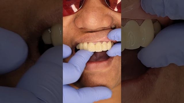 FIXED BRIDGE PORCELAIN ZIRCONIA смотреть онлайн