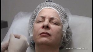 Носогубная складка коррекция канюлей