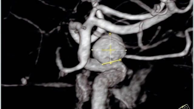 Эмболизация аневризмы внутренней сонной артерии