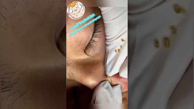 #прыщи #черныеточки