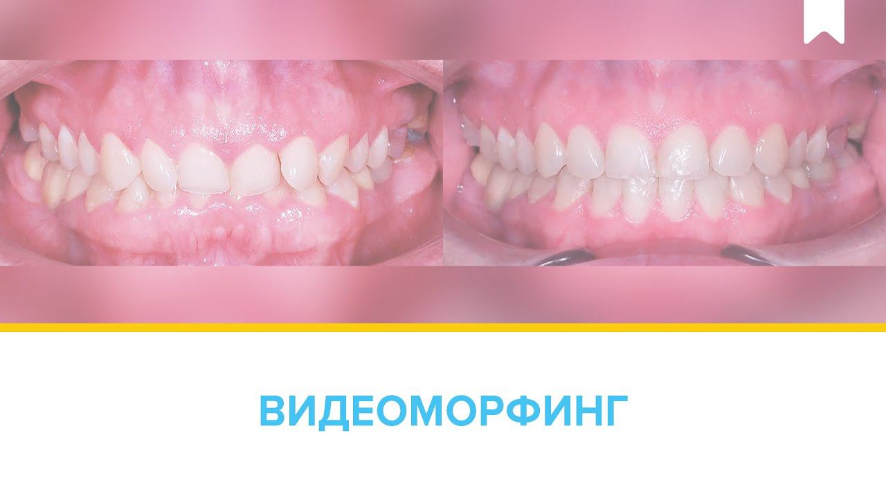 Лечение глубокого прикуса цифровыми брекетами INSIGNIA за 2 года.