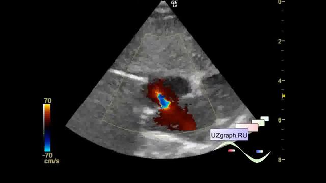 Детская Эхокардиография - Межпредсердное сообщение смотреть онлайн