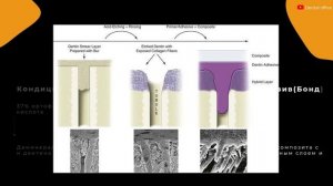 Адгезивы в стоматологии |Материаловедение |Вебинар по стоматологии