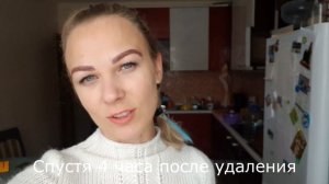 Удаление татуажа бровей. ЛАЗЕР vs РЕМУВЕР.