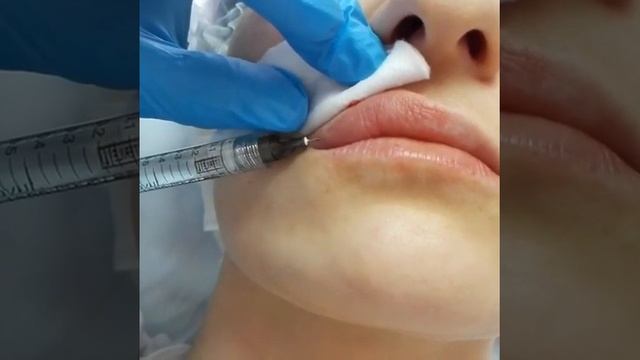 Увеличение губ, доктор Ирина Юлдашева смотреть онлайн