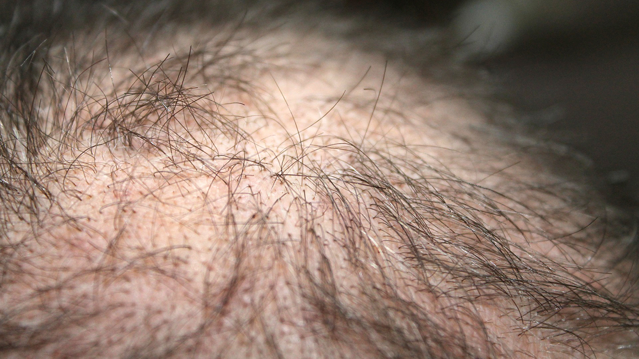 волосы на груди у мужчин выпадают волосы фото 108
