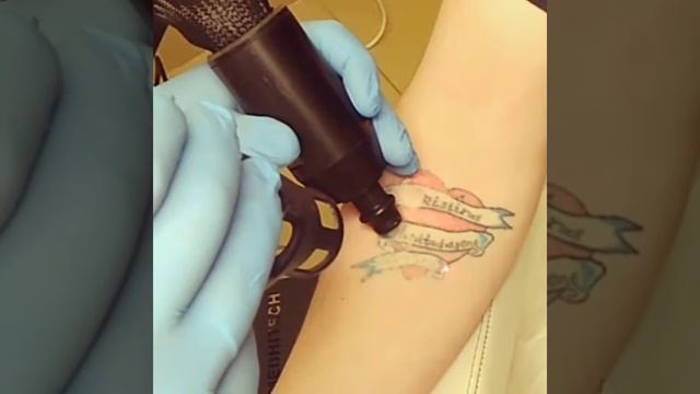 Удаление татуировки Воронеж смотреть онлайн