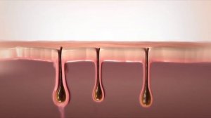 Фотоэпиляция, технология IPL